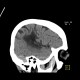 Postischemic gliosis of brain, dense artery: CT - Computed tomography